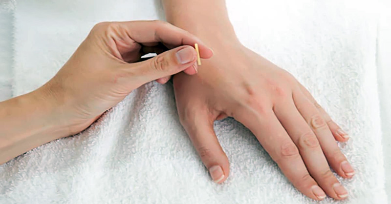 Châm cứu huyệt Đại Bạch dưới sự thực hiện của bác sĩ Đông y