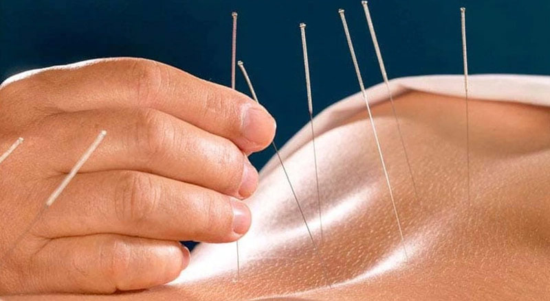 Châm cứu huyệt Bát Liêu được thực hiện bởi chuyên gia