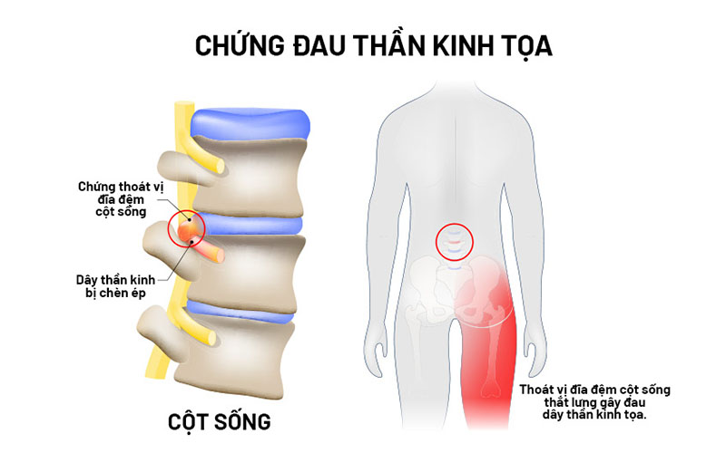 Nguyên nhân gây đau thần kinh tọa