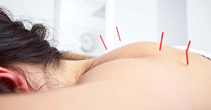 Châm cứu huyệt Đại Chùy hỗ trợ điều trị các bệnh lý mãn tính