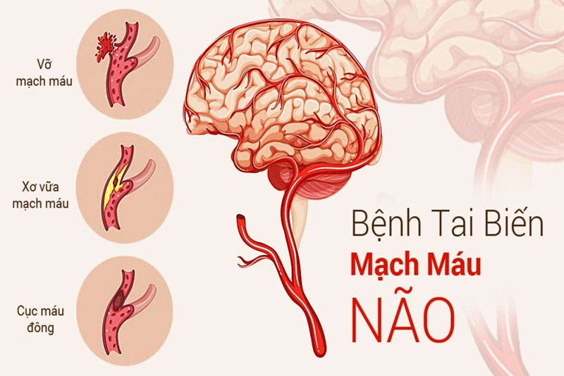Bấm huyệt cho người bị tai biến