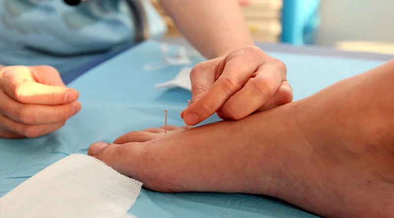 Kỹ thuật châm cứu huyệt Bát Phong không đơn giản nên thực hiện bởi chuyên gia