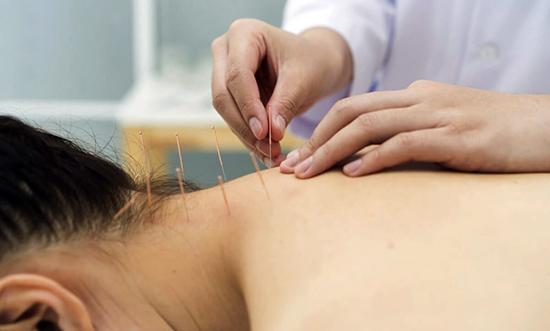 Châm cứu huyệt Phong Trì được thực hiện bởi bác sĩ Đông y