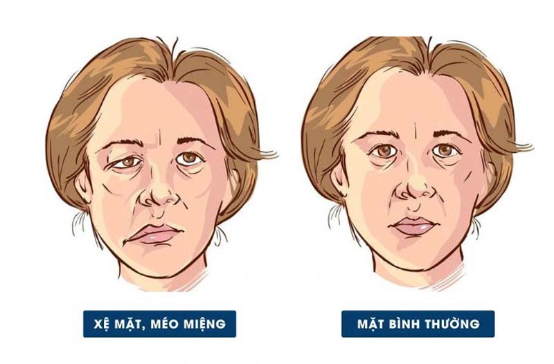 Huyệt Đầu Duy hỗ trợ phục hồi chức năng cơ mặt do liệt mặt ngoại biên