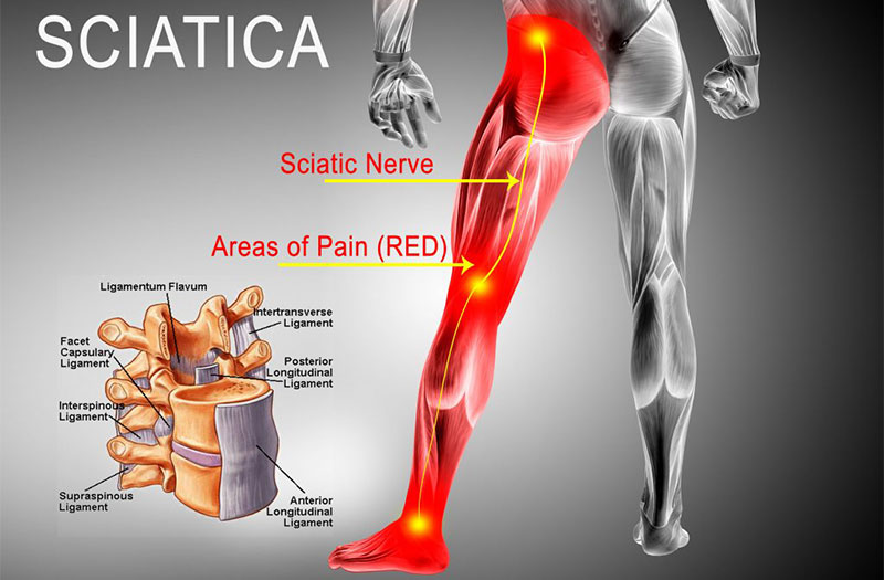 Đau thần kinh tọa