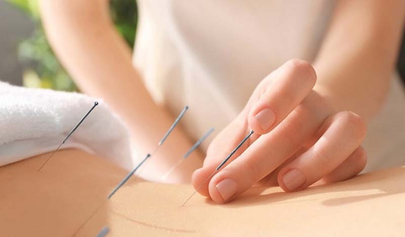 Châm cứu huyệt Chí Dương được thực hiện bởi chuyên gia