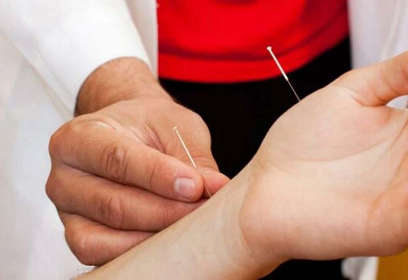 Châm cứu huyệt Ngoại Quan kết hợp với các huyệt khác trên tay