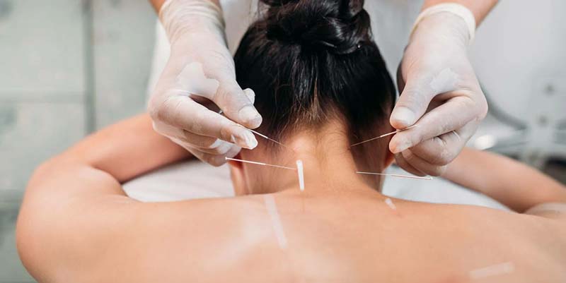 Châm cứu giúp lưu thông, kích thích khí huyết, làm giảm áp lực lên cơ cổ vai gáy