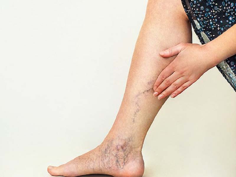 Giãn tĩnh mạch là tình trạng tĩnh mạch phình to, ngoằn ngoèo nổi rõ trên bề mặt da