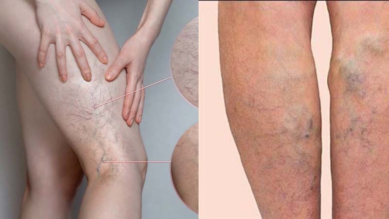 Suy giãn tĩnh mạch nặng với tình trạng sưng phồng, viêm thành khối