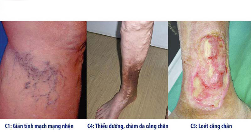 Can thiệp y tế bắt buộc ở giai đoạn cuối chân bị giãn tĩnh mạch