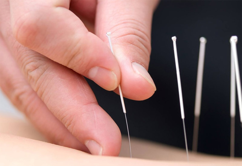 Châm cứu huyệt Thủy Đạo điều trị các bệnh lý mãn tính