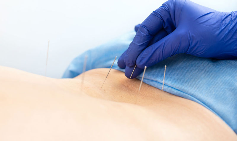 Châm cứu huyệt Tứ Mãn thực hiện bởi chuyên gia