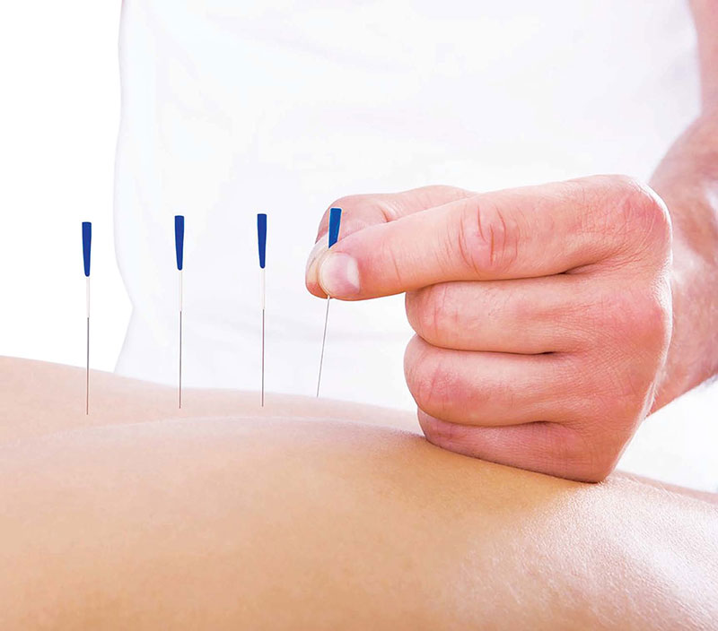 Châm cứu sử dụng kim châm vào các huyệt đạo trên cơ thể