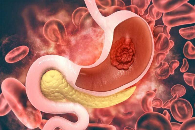 Huyệt giúp giảm đau dạ dày nhanh chóng