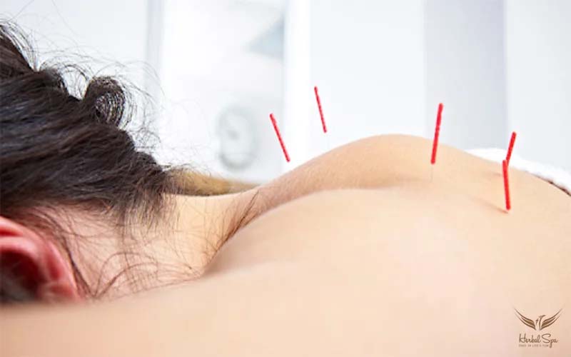 Thực hiện châm cứu huyệt Phế Du bởi chuyên gia giàu kinh nghiệm