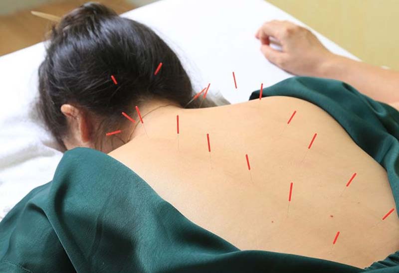 Châm cứu huyệt Tâm Du đúng kỹ thuật