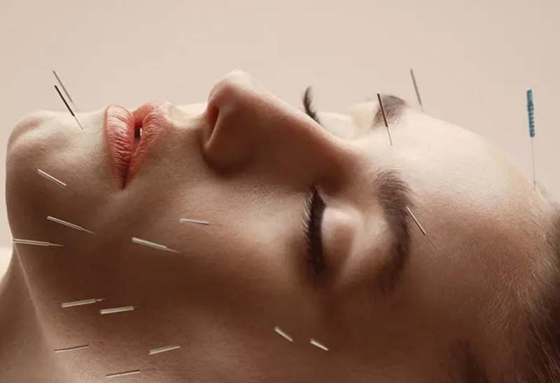 Thật cẩn trọng khi châm cứu huyệt Giáp Xa