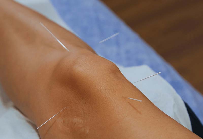 Châm cứu huyệt Lương Khâu kết hợp cùng các huyệt vùng đầu gối