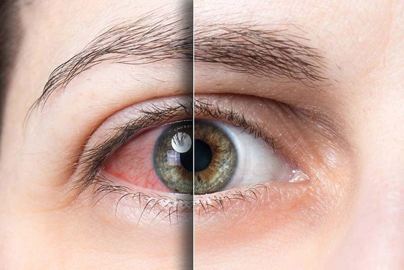 Tác dụng huyệt Tình Minh trong điều trị các bệnh về mắt