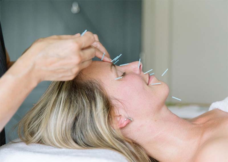 Châm cứu huyệt Ty Trúc Không được thực hiện bởi bác sĩ Y học cổ truyền