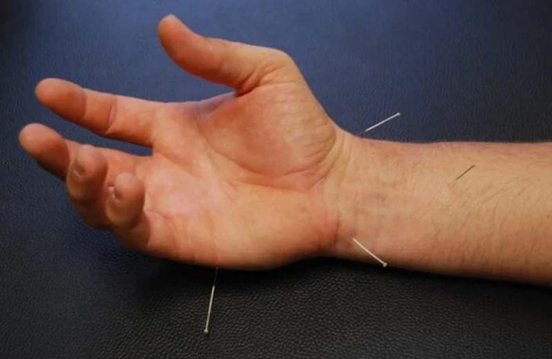 Kết hợp châm cứu huyệt Thái Uyên và các huyệt trên tay, cổ tay
