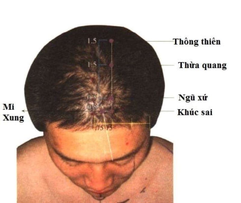 Các huyệt trên đầu