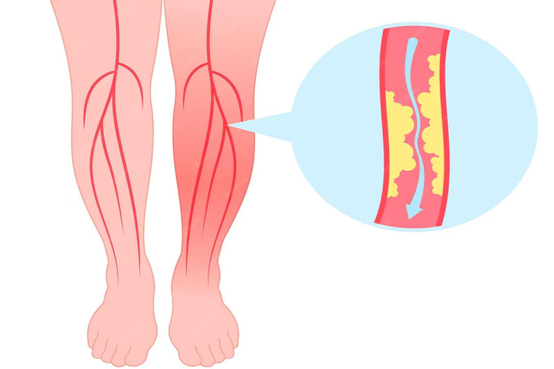 Xơ vữa động mạch là nguyên nhân hàng đầu gây tắc nghẽn mạch máu chân