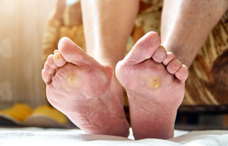 Tắc nghẽn mạch máu chân nghiêm trọng gây viêm loét khó lành