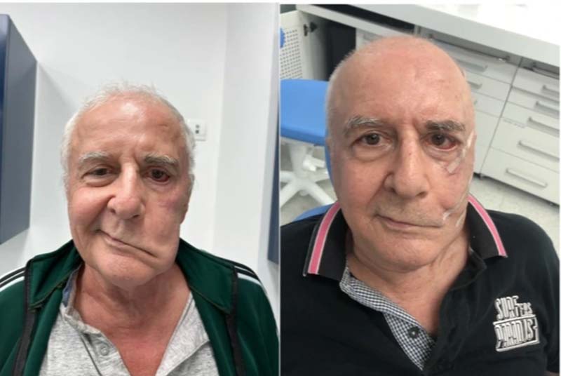 Tác dụng huyệt Ngư Yêu trong điều trị chứng liệt mặt