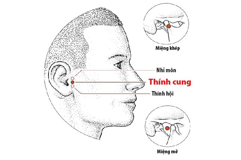 Vị trí huyệt Thính Cung