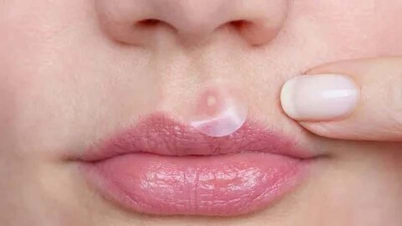 Mọc mụn ở Nhân Trung cho thấy sức khỏe đang có vấn đề