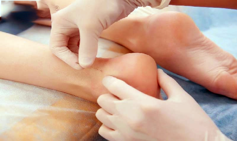 Châm cứu huyệt Thái Khê