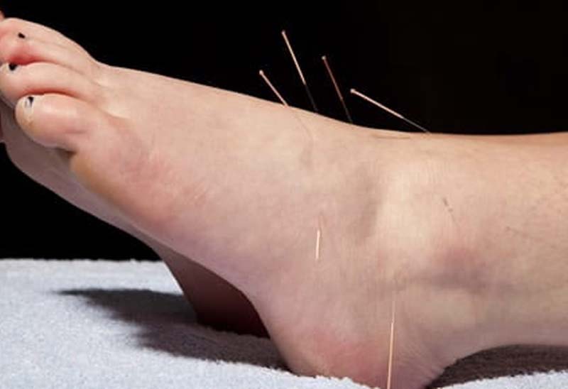 Châm cứu huyệt Giải Khê điều trị các bệnh lý mãn tính