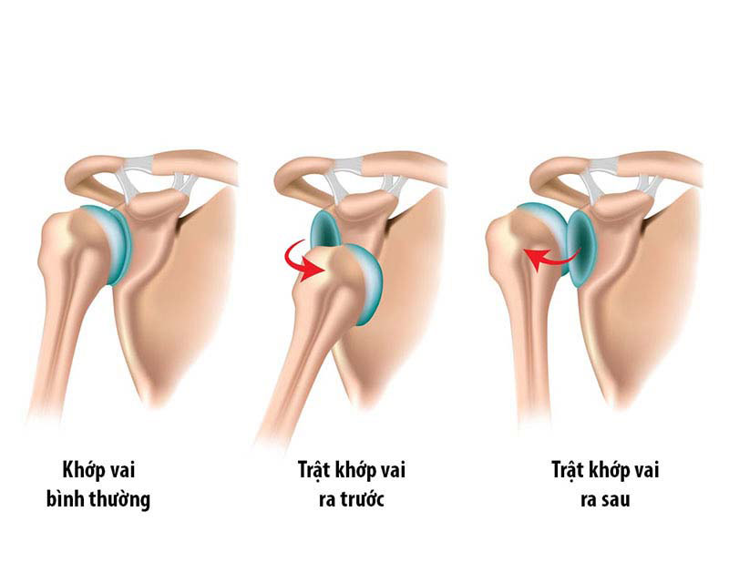 Trật khớp xương vai gây ra đau cổ vai gáy bên phải
