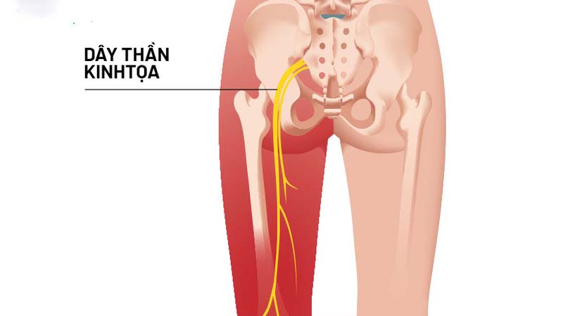 Đau dây thần kinh tọa gây chèn ép gây đau các khớp tay chân