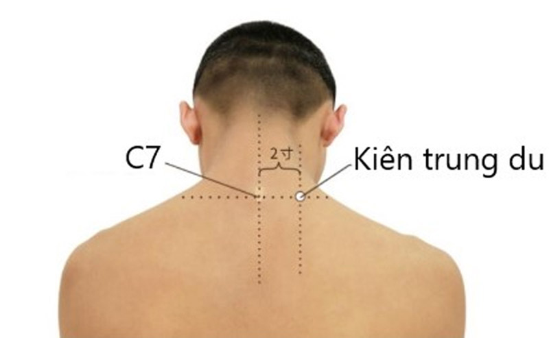 Kiên Trung Du là một trong các các huyệt vùng cổ vai gáy điển hinh