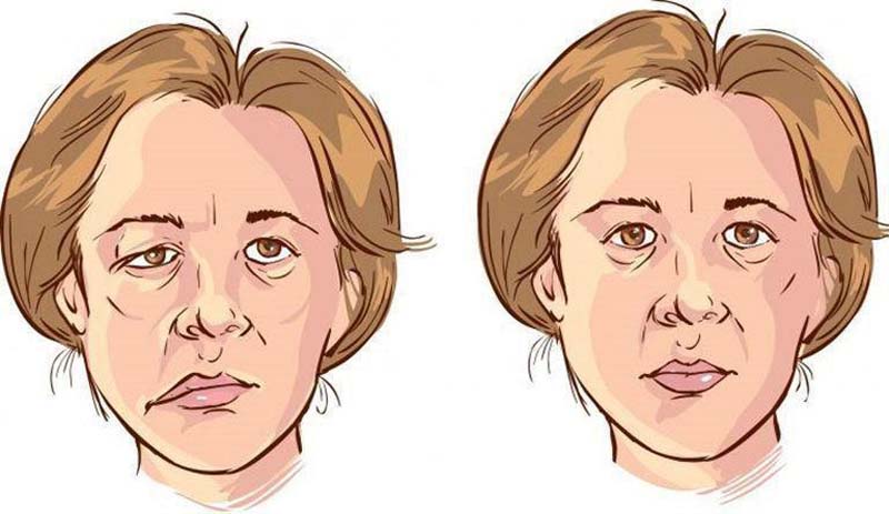 Huyệt Địa Thương có tác dụng gì? Hỗ trợ điều trị méo miệng, liệt mặt