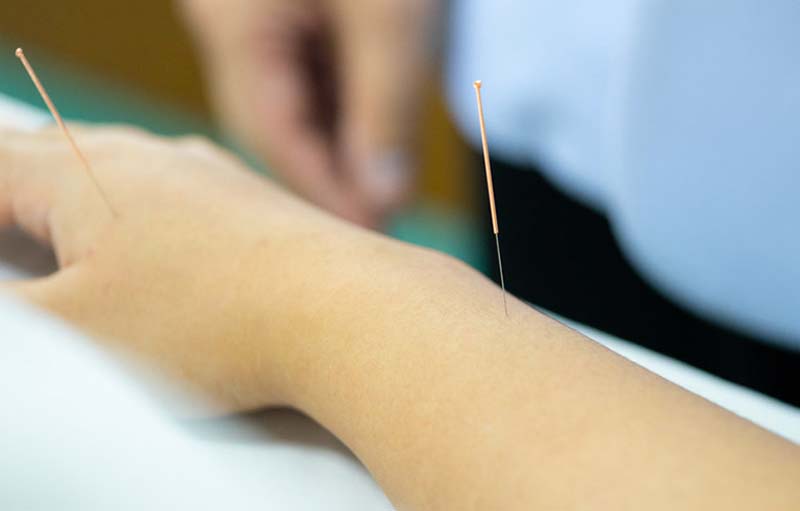 Châm cứu huyệt Dương Trì tại cơ sở y tế uy tín