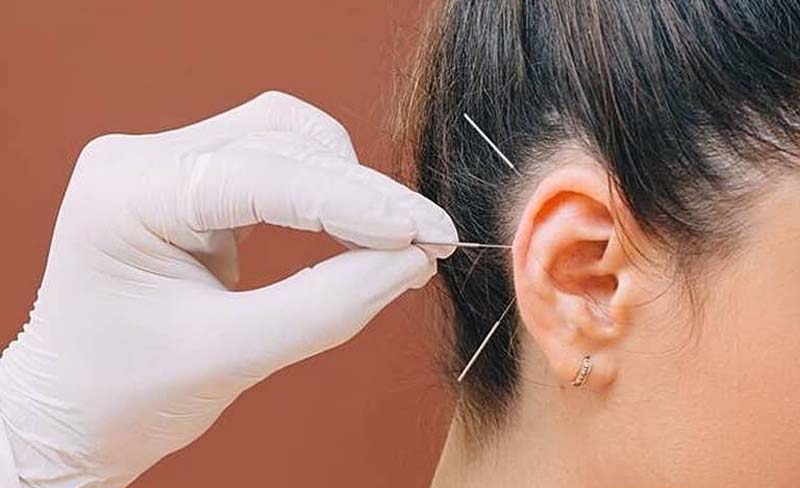 Không phải ai cũng sử dụng được phương pháp nhĩ châm