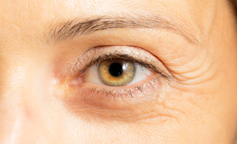 Nguyên nhân hình thành nếp nhăn quanh mắt