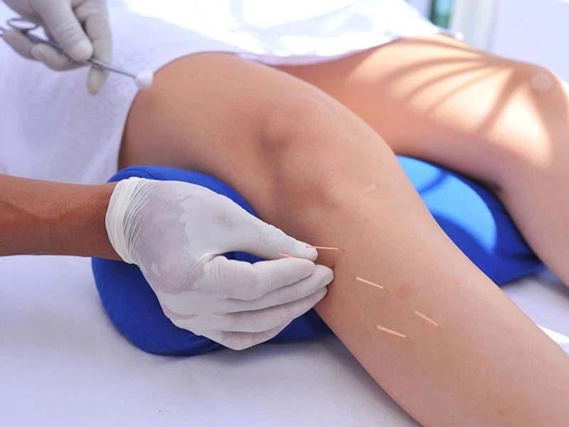 Châm cứu huyệt Dương Lăng Tuyền tại cơ sở Đông y uy tín