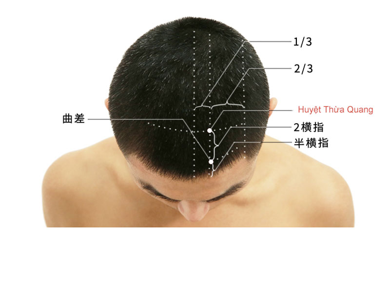 Vị trí huyệt Thừa Quang nằm trên đỉnh đầu