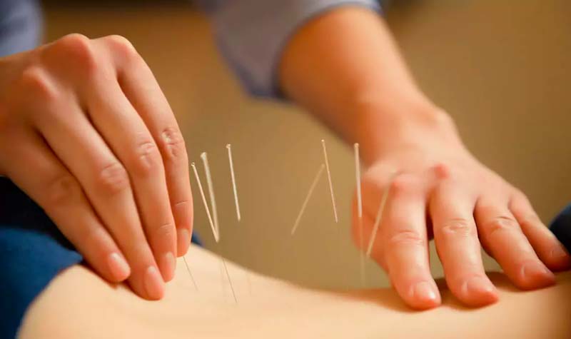 Châm cứu huyệt Hạ Liêu với kỹ thuật cao