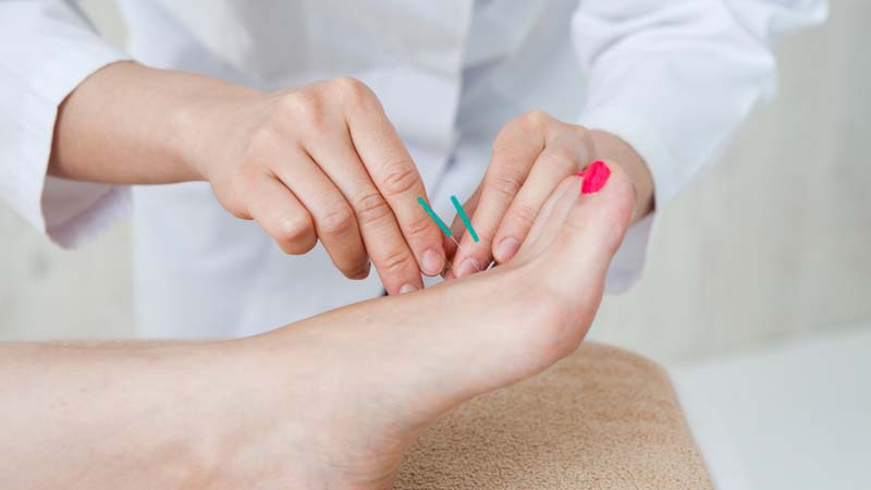 Châm cứu huyệt Đại Đô được thực hiện bởi bác sĩ có chuyên môn cao