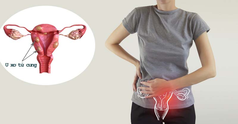U xơ tử cung là bệnh lý điển hình gây đau lưng khi đến tháng