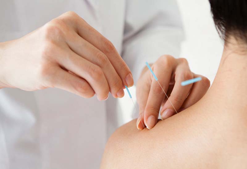 Châm cứu huyệt Kiên Ngung điều trị các bệnh lý mãn tính