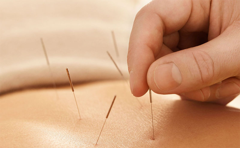 Dùng kim châm cứu lên huyệt Tử Cung