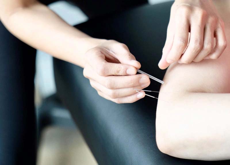 Châm cứu huyệt Khúc Trì nhằm điều trị các bệnh lý mãn tính