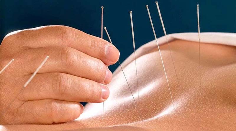 Châm cứu huyệt Trật Biên tại cơ sở y tế uy tín